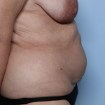 Tummy Tuck Before & After Patient #34291